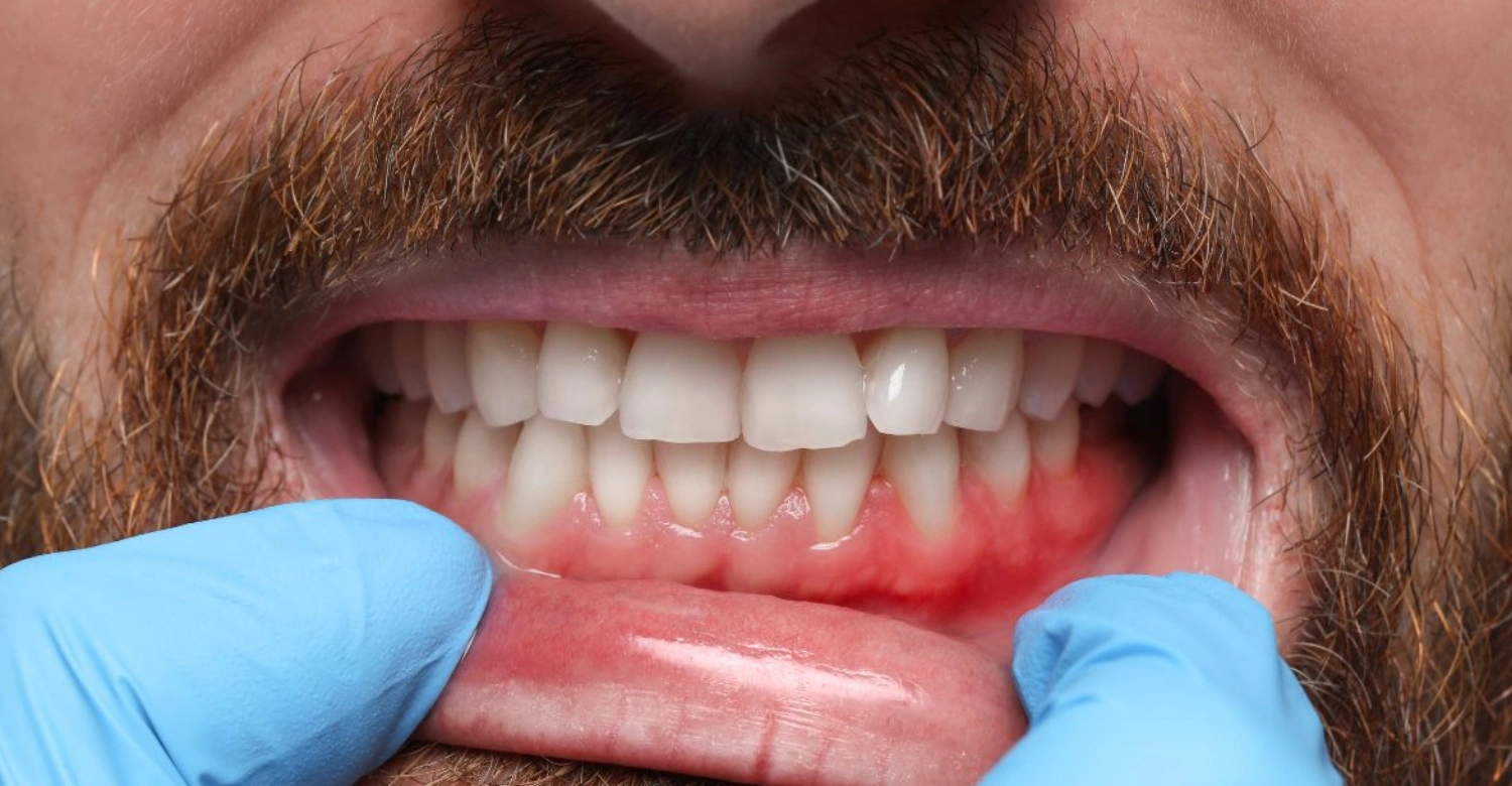 What cause periodontitis Inblog